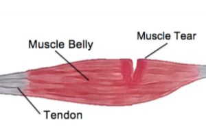Muscle-Tear-Feature-Image-300x192.jpg
