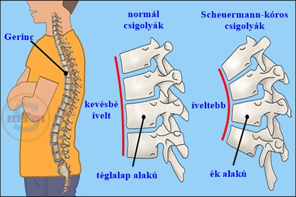 Scheuermanns-betegseg.jpg