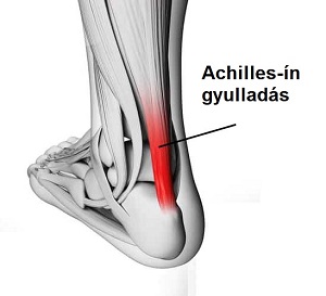 achilles-in-gyulladasa.jpg