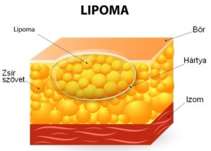 lipoma1-300x214.jpg