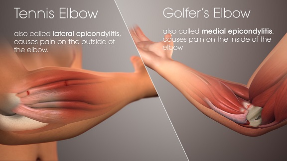 tennis-golf-elbow.jpg