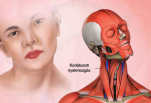 torticollis