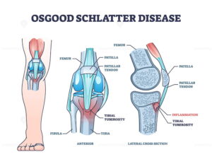 Osgood-Schlatter-300x225.jpg