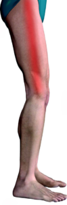 iliotibial-band-syndrome-99x300.png