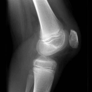 Chondromalacia-Patellae-300x300.jpg