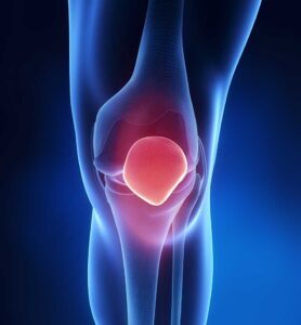 Patellofemoral-pain-syndrome-278x300.jpg
